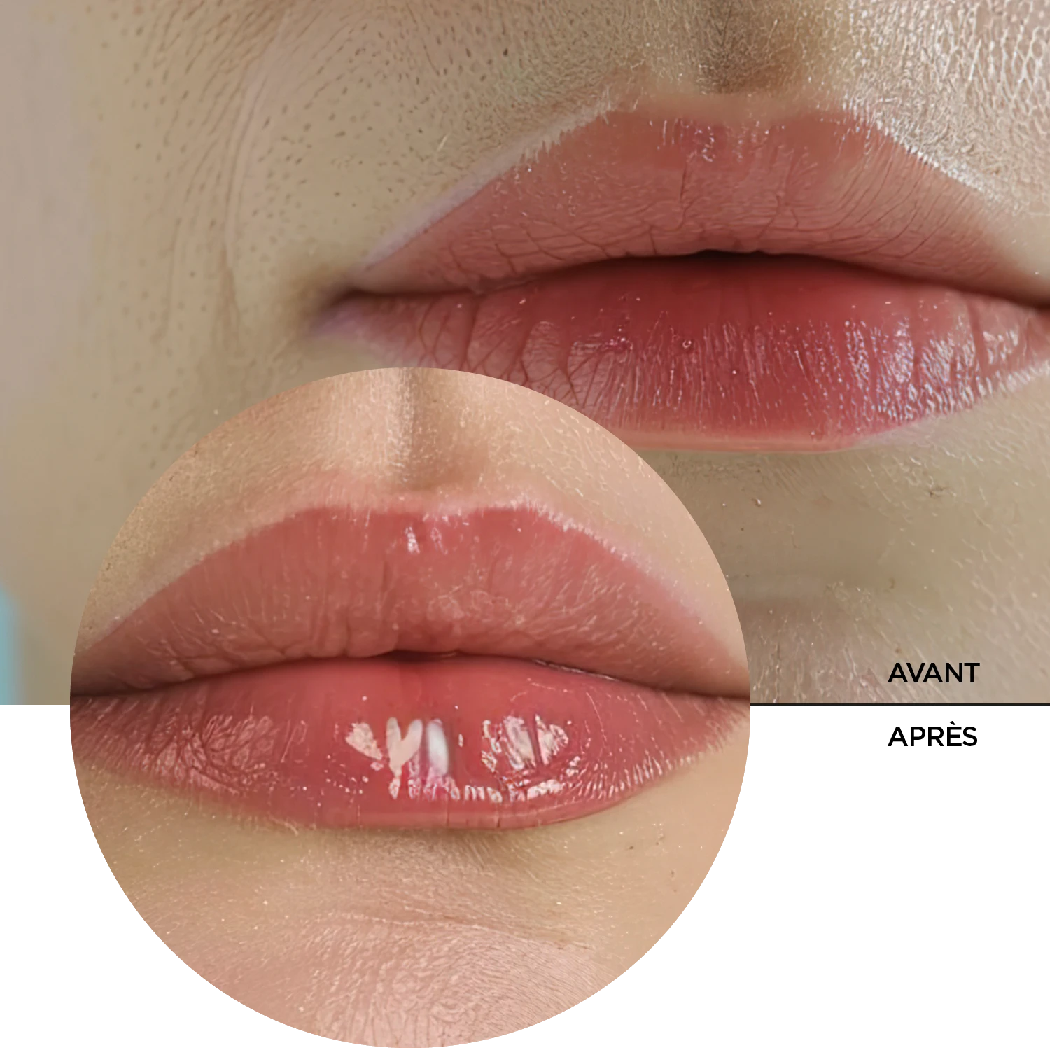 LIP FILLER Acide Hyaluronique – Image 8